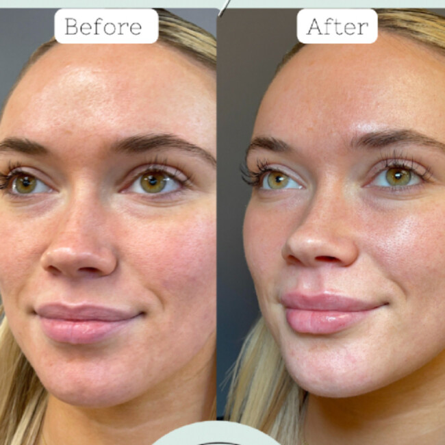 Hello Hydration before and after lip filler